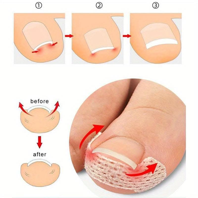 10 pcs. Ingrown Toenail Correction Stickers - Paronychia Treatment Patches