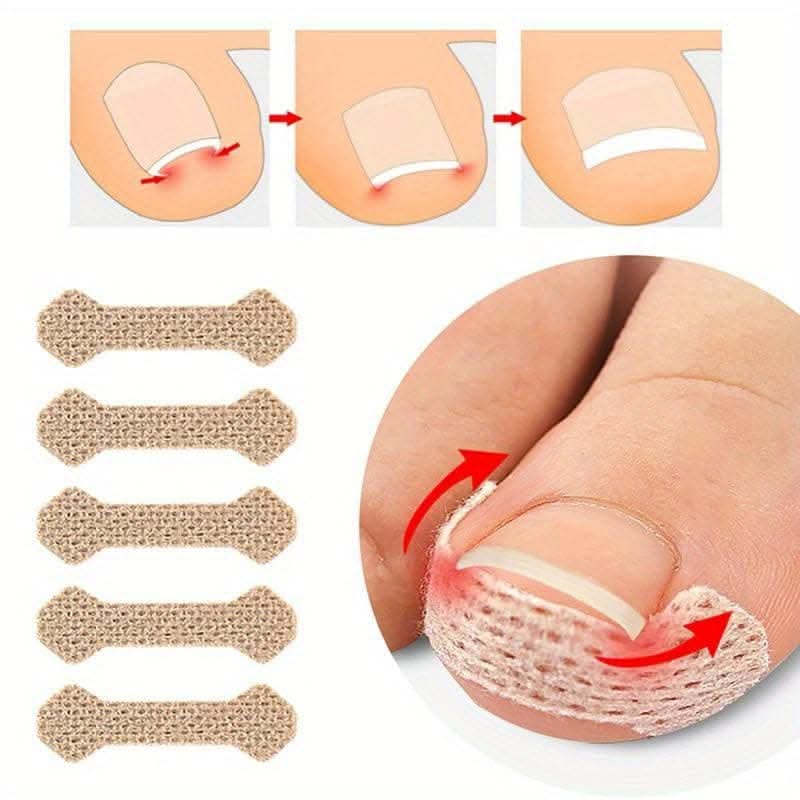 10 pcs. Ingrown Toenail Correction Stickers - Paronychia Treatment Patches